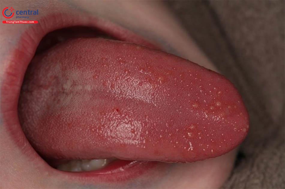 Sùi Mào Gà ở Lưỡi Triệu chứng, Nguyên nhân và Phương pháp điều trị